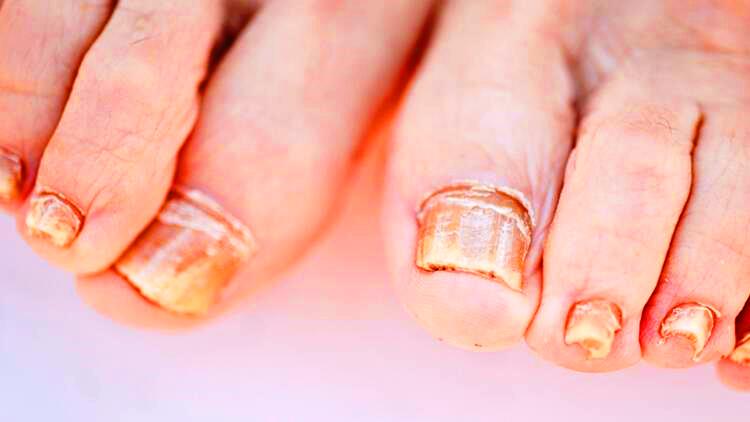 Dermatoloji uzmanı uyardı! Tırnak tümörleri tırnak mantarıyla karışabiliyor